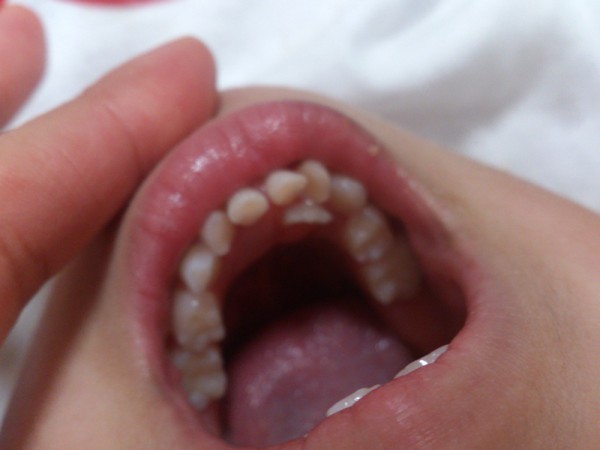 乳歯 永久歯